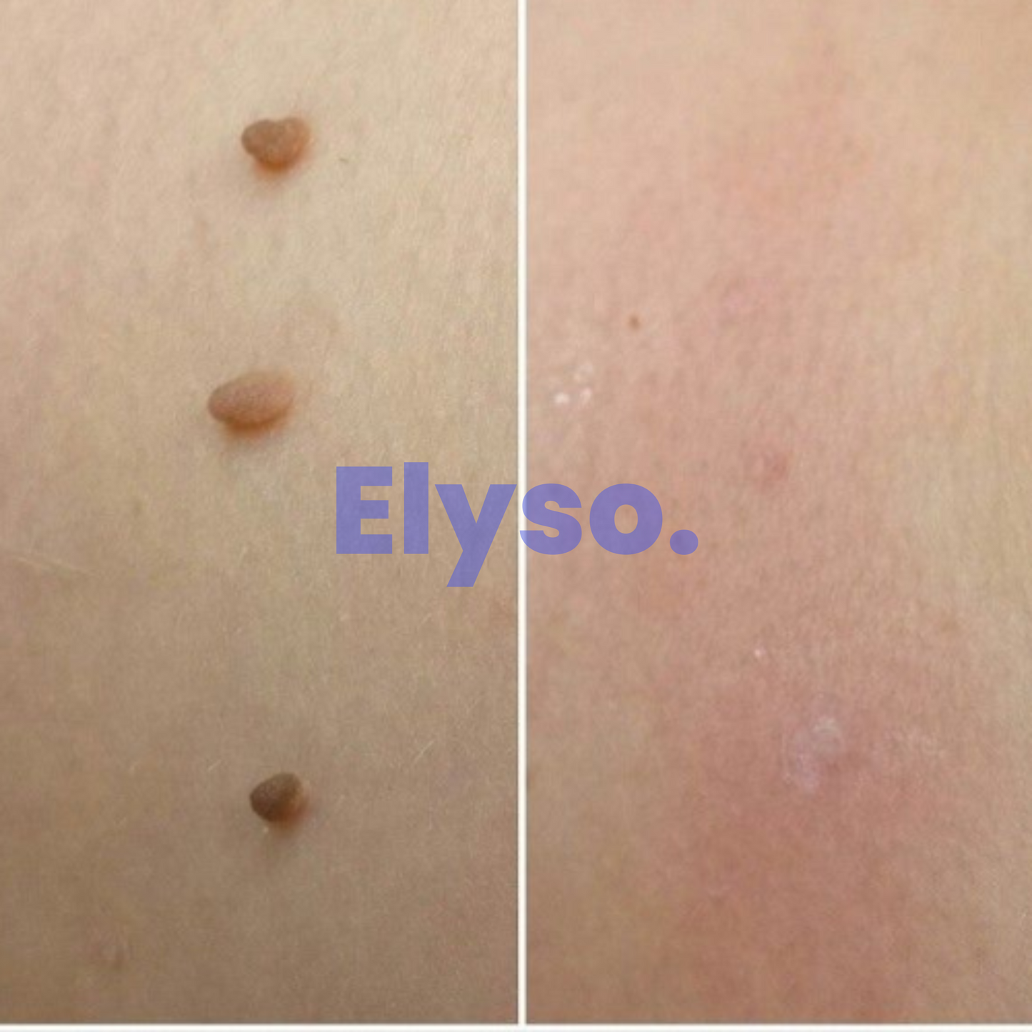 Elyso® PureTag