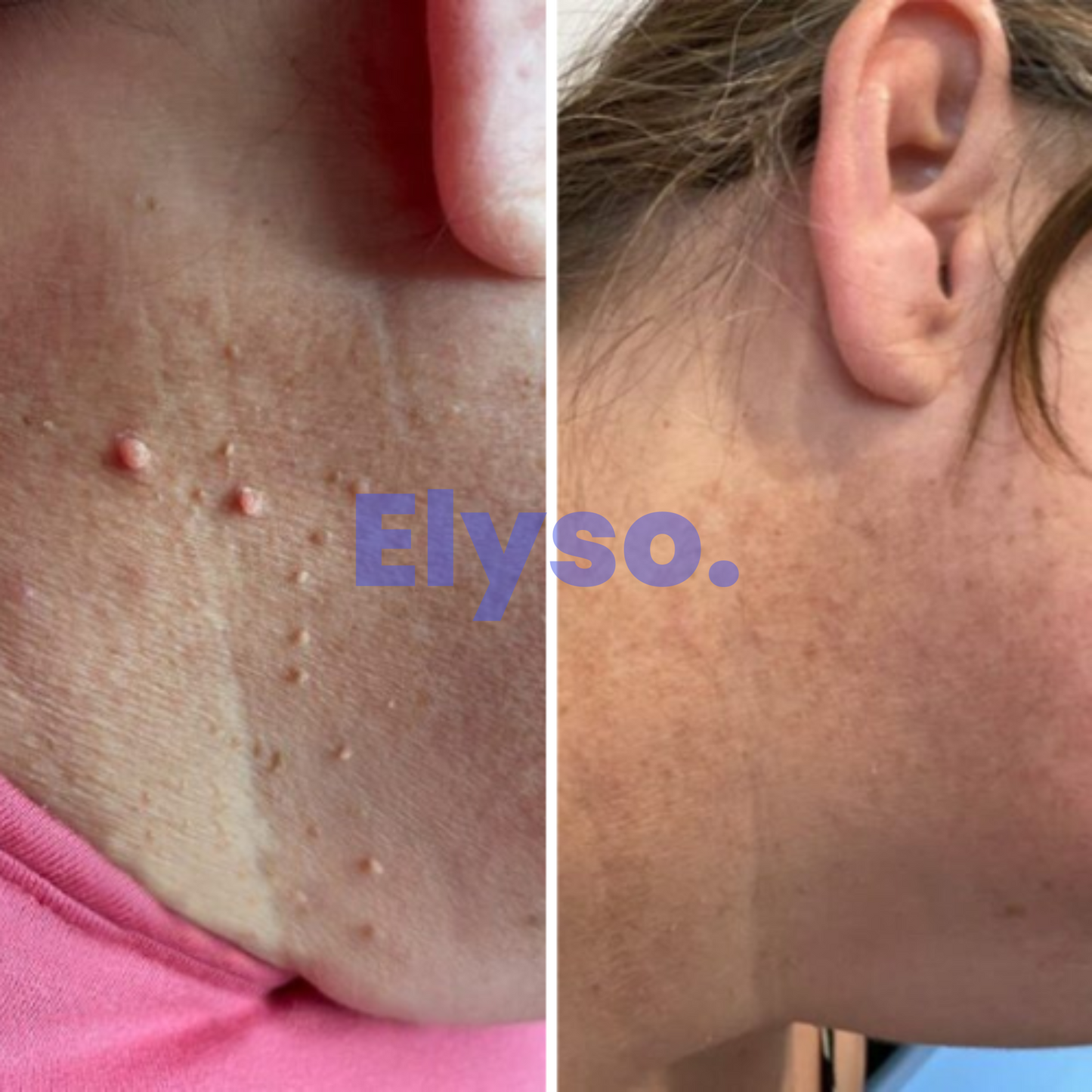 Elyso® PureTag