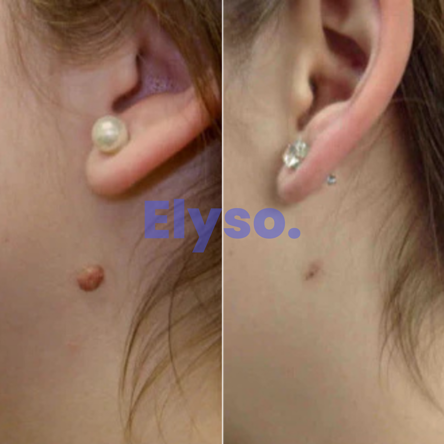 Elyso® PureTag