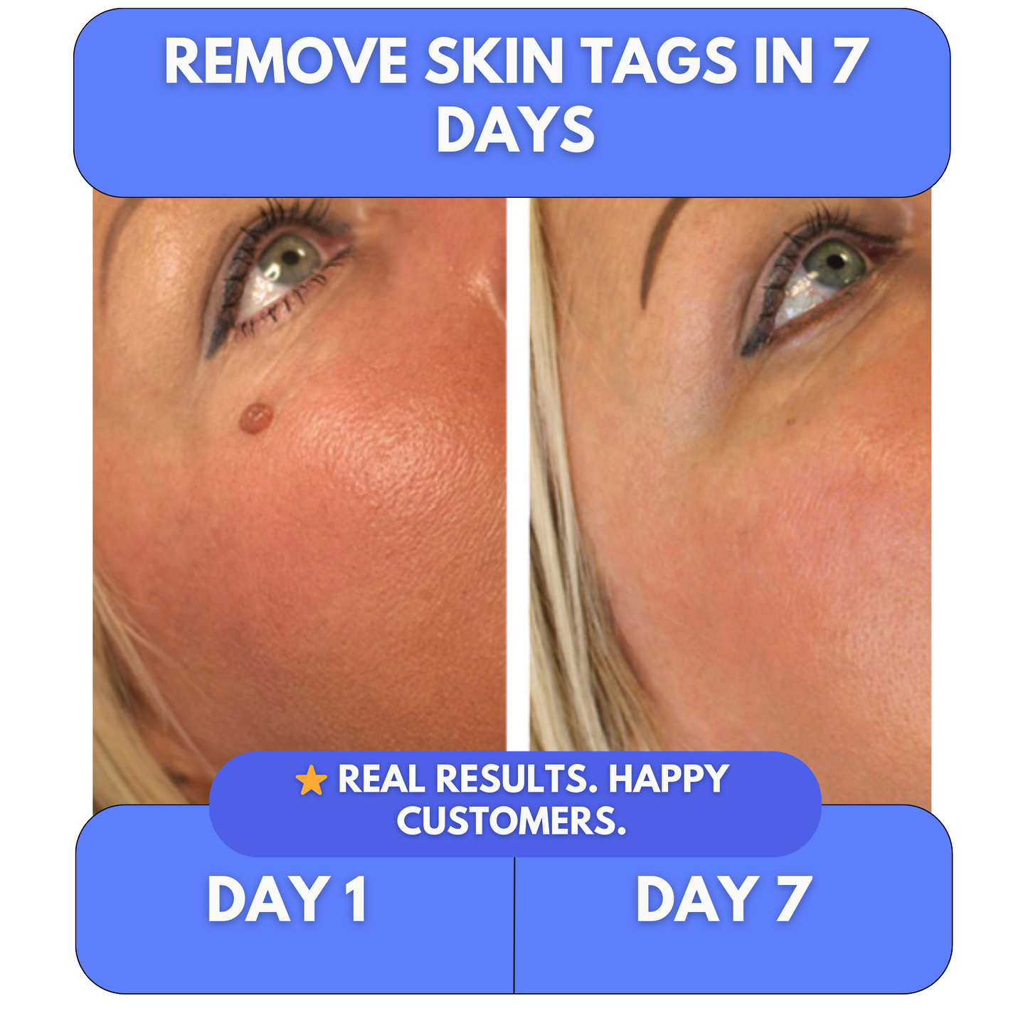 Say Goodbye to Skin Tags — From Home