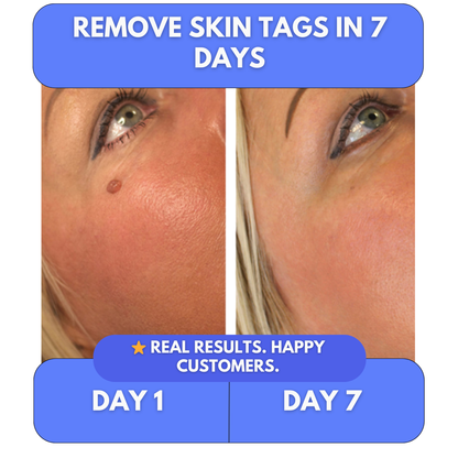 Say Goodbye to Skin Tags — From Home