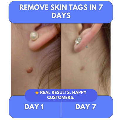 Say Goodbye to Skin Tags — From Home