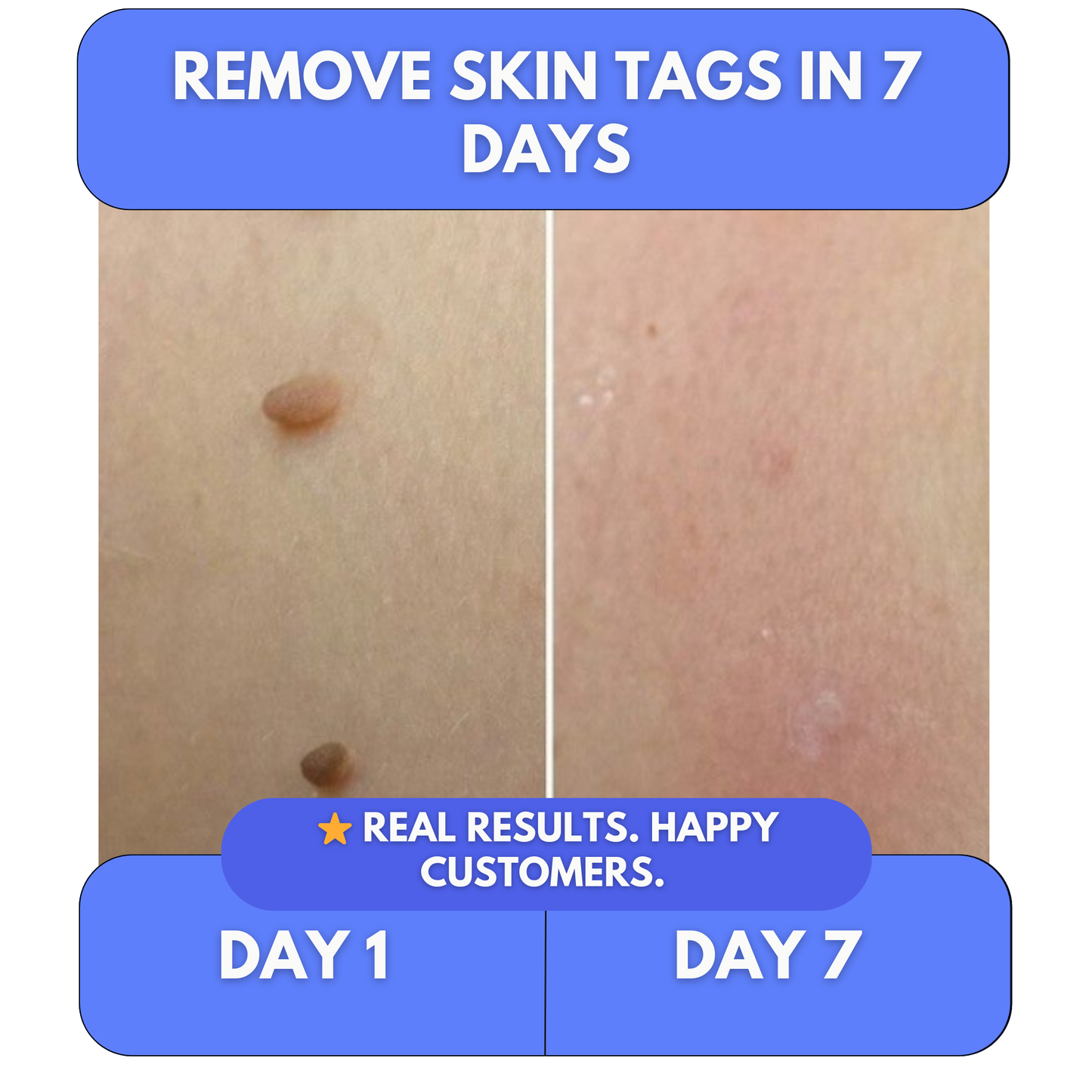 Say Goodbye to Skin Tags — From Home