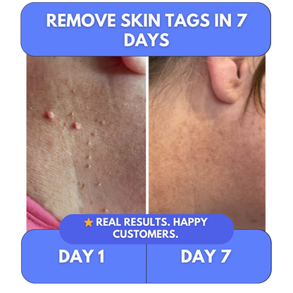 Say Goodbye to Skin Tags — From Home