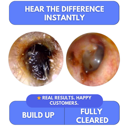 Clear Blocked Ears in Minutes — At Home