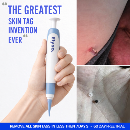 Say Goodbye to Skin Tags — From Home